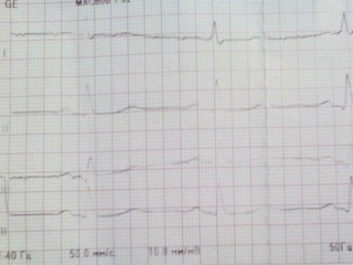 Электрокардиограмма сердца расшифровка пример