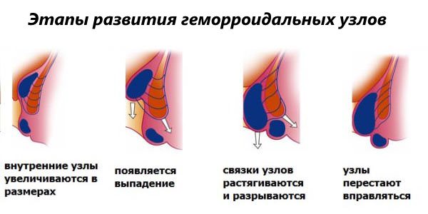Этапы развития геморроидальных шишек