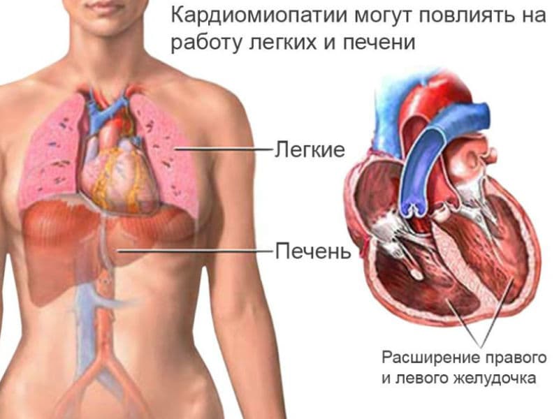 Вторичная кардиопатия