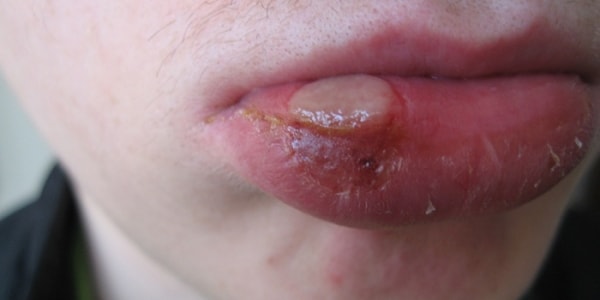 язвенный шанкр на губе при сифилисе