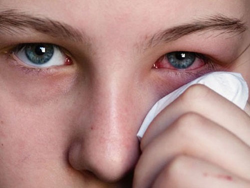 Признаки аллергии на глазах