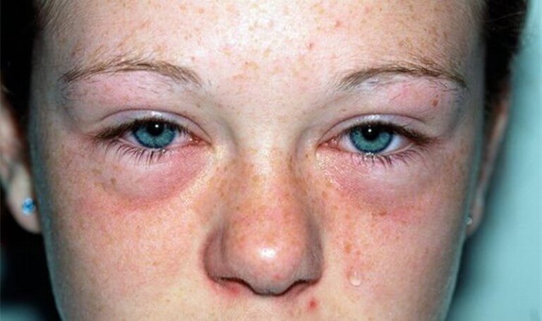 Аллергический отек лица