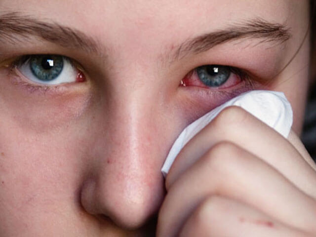 При аллергии на глазах необходимо использовать мазь
