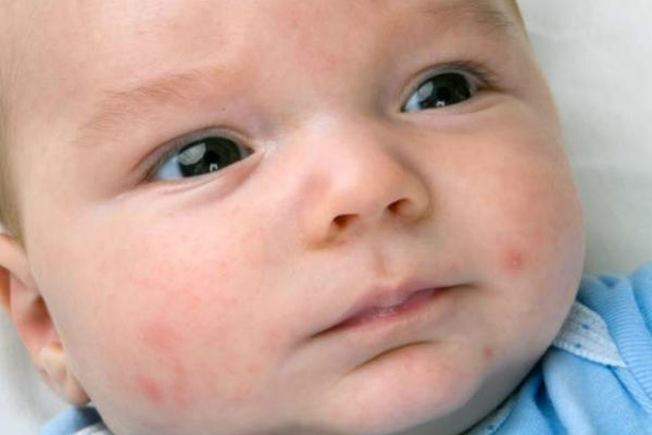Кожный дерматит у детей