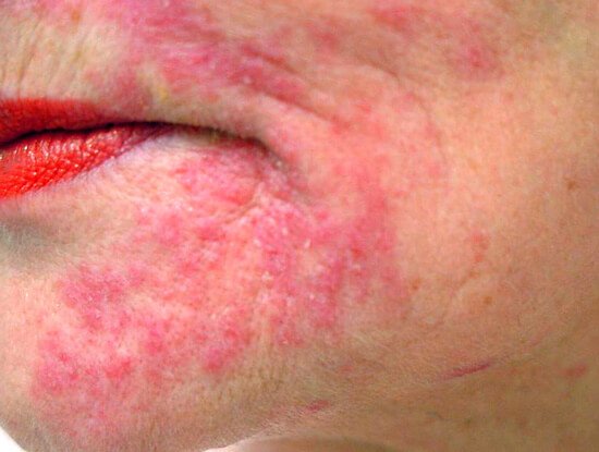 Как выглядит аллергический дерматит