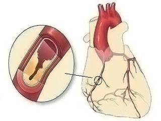Что такое ишемия сердца