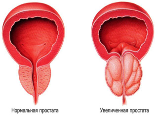 Увеличенная простата