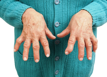 Ревматоидный артрит