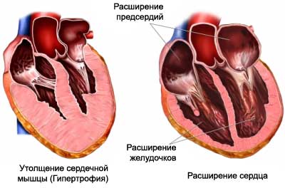 Виды патологии сердца