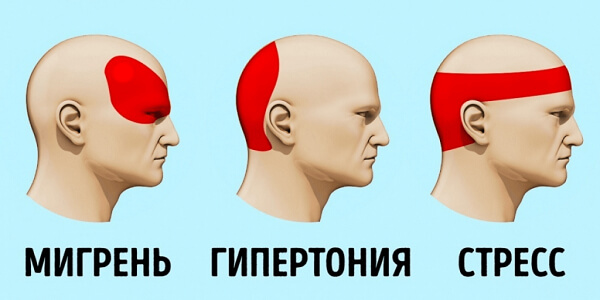 Локализации головной боли