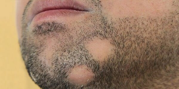 Очаговое облысение в области бороды